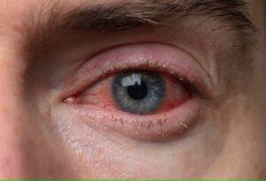 Symptoms of Eye Burning